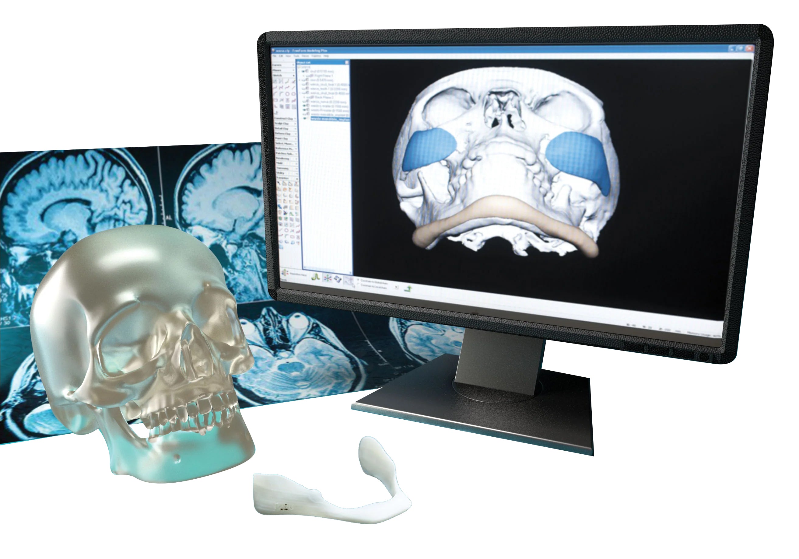 Implantech 3d Accuscan Patient Specific Custom Implants